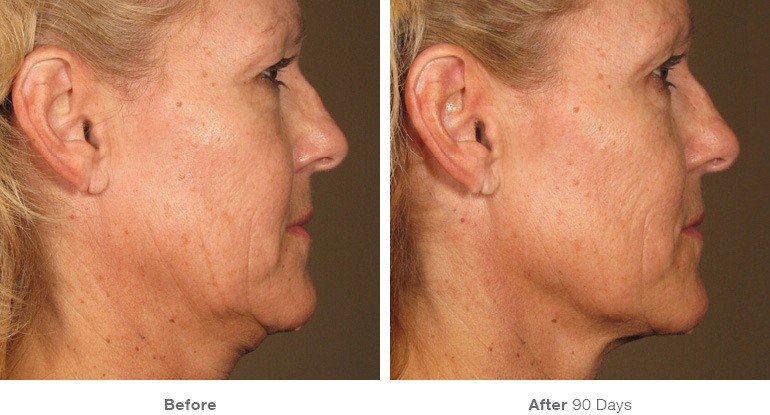 Ultherapy before and after results