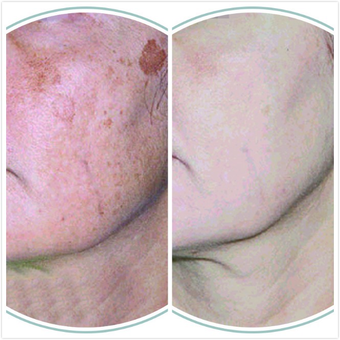 Mesoestetic Cosmelan before and after photo